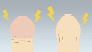 カントン包茎・真性包茎にはカントン腫れのリスクが！対処法について解説