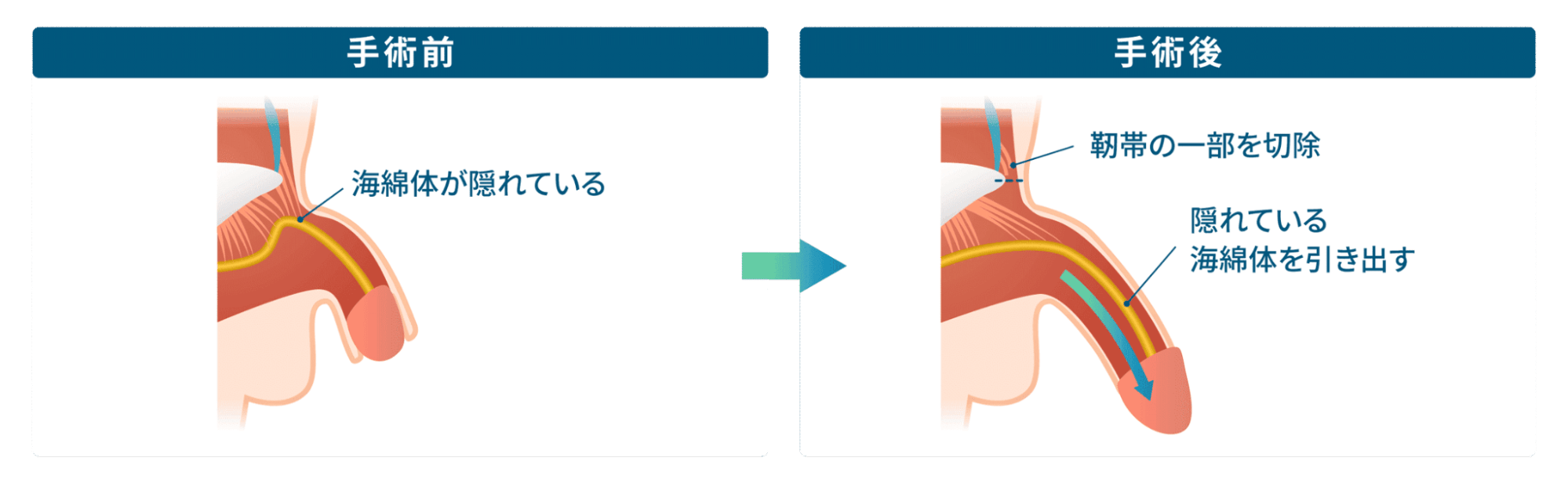 切開長茎術(埋没部露出術)。手術前：海綿体が隠れている。手術後：靭帯の一部を切除。隠れている海綿体を引き出す。