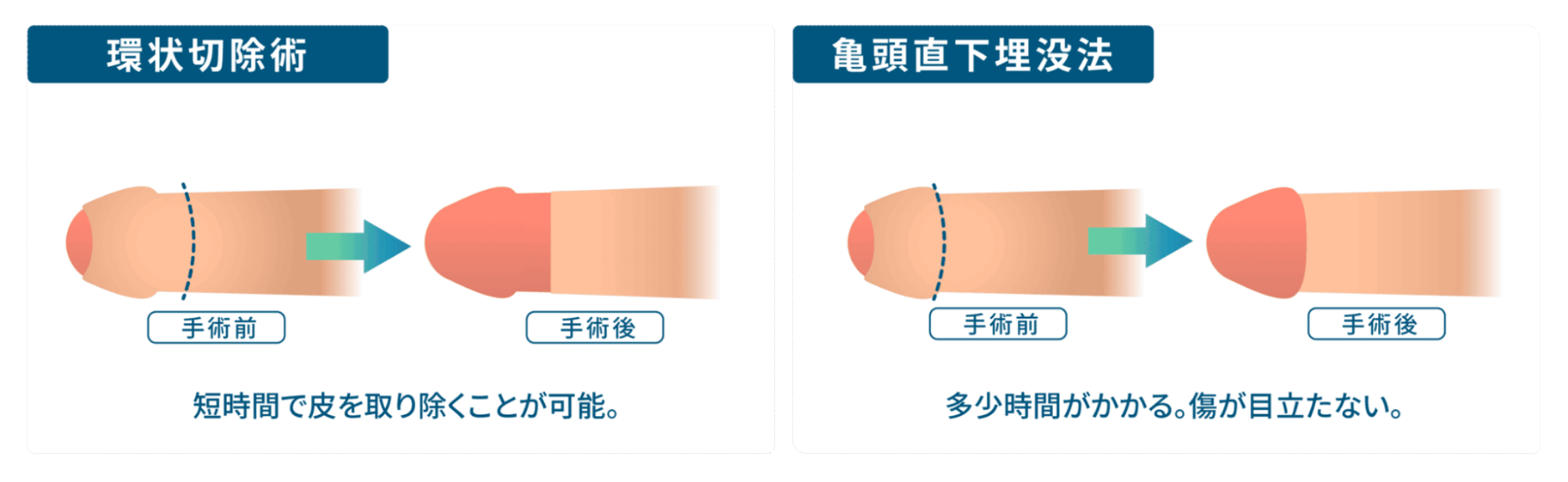 環状切除術：短時間で皮を取り除くことが可能。亀頭直下埋没法：多少時間がかかるが傷跡が目立たない。