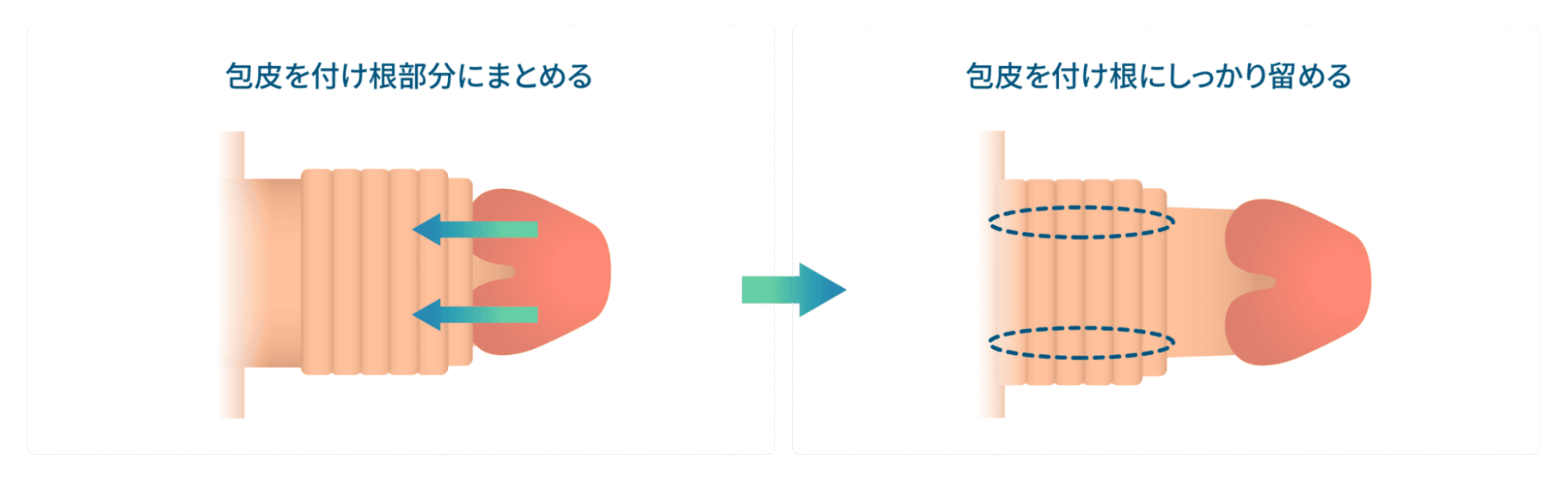 非切開包茎治療：①包皮を付け根部分にまとめる。②包皮を付け根にしっかり留める。