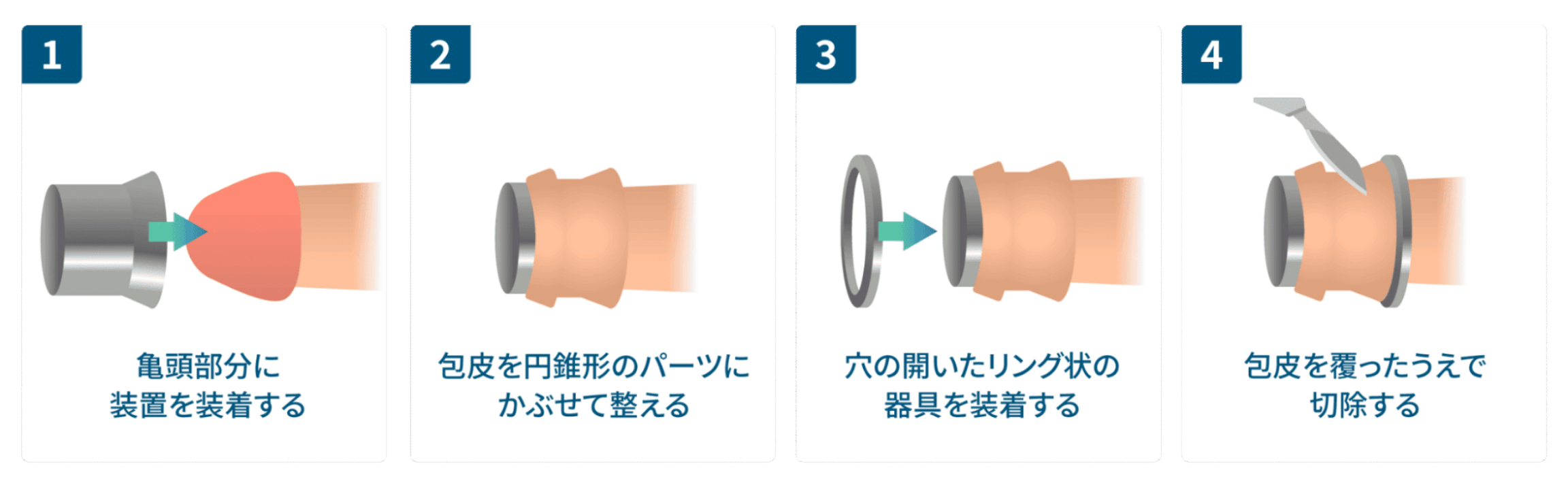 ABC式CSカット：①亀頭部分に装置を装着。②包皮を円錐状にパーツにかぶせて整える。③穴の開いたリング状の器具を装着する。④包皮を覆ったうえで切除する。