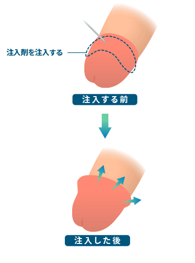 亀頭増大術：亀頭部を中心に注入剤を注入する