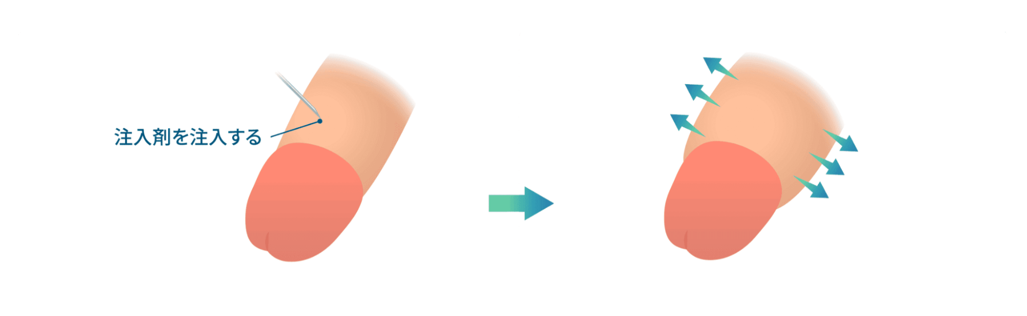 陰茎増大術：陰茎部に注入剤を注入する
