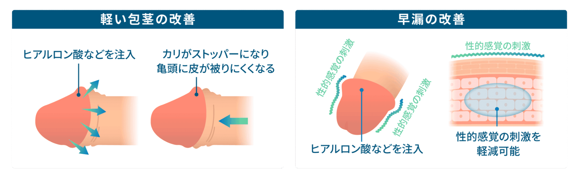 軽い包茎の改善：ヒアルロン酸などを注入。カリがストッパーになり亀頭に皮が被りにくくなる。早漏の改善：ヒアルロン酸などを注入。性的感覚の刺激を軽減可能。
