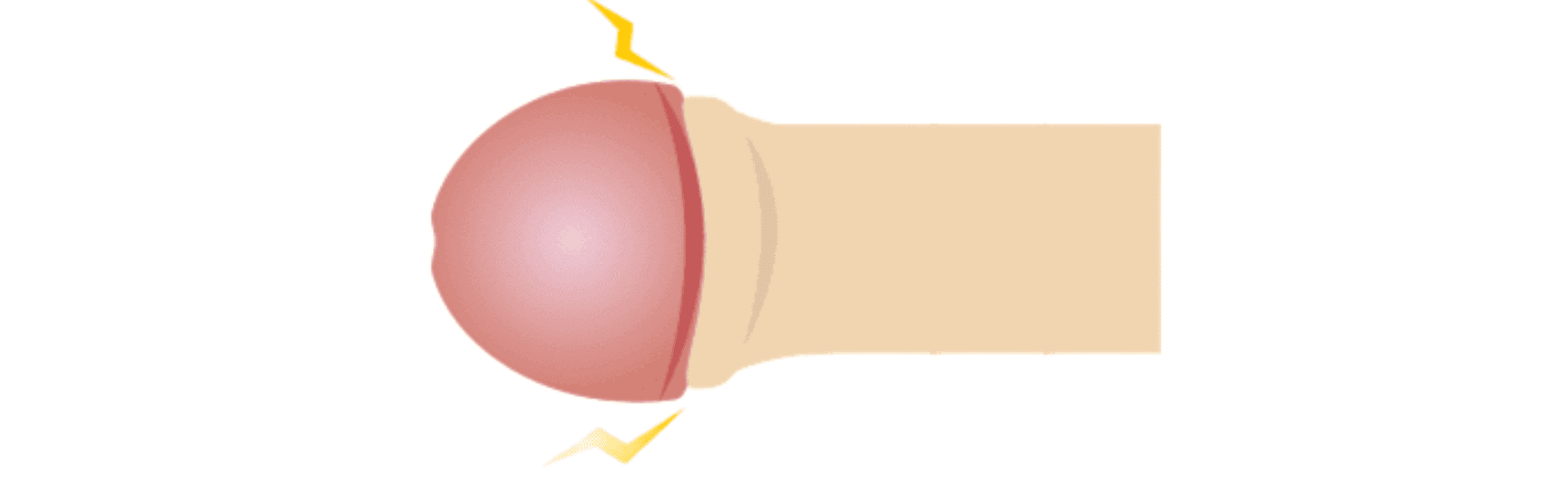 カントン包茎（かんとんほうけい）