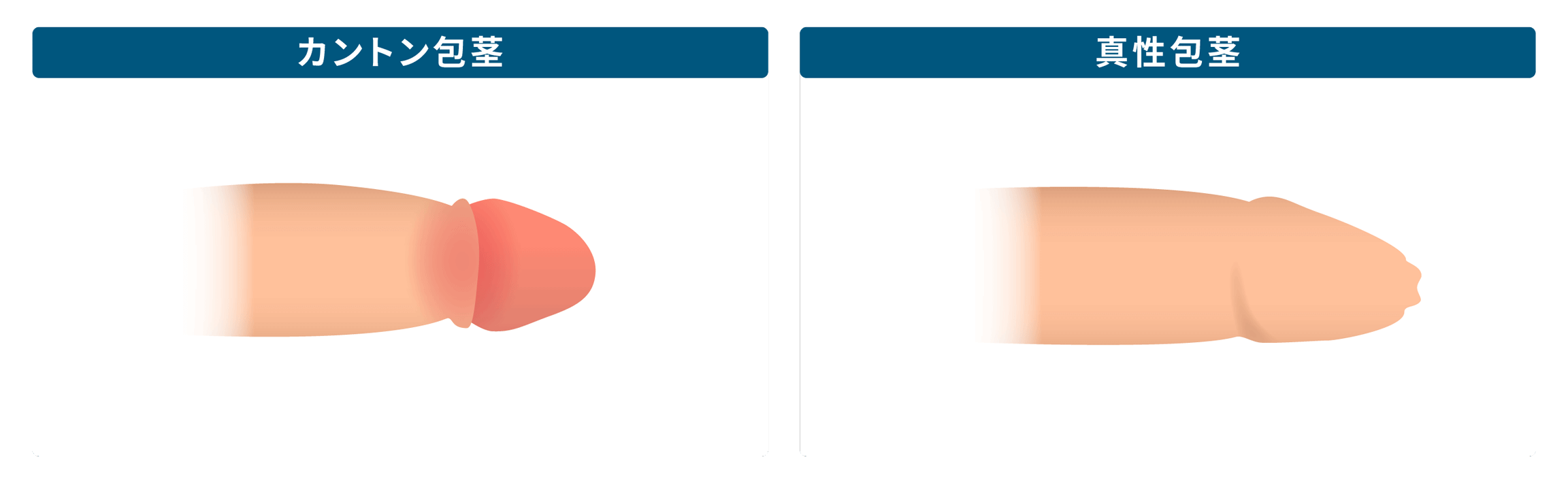 カントン包茎と真性包茎の違い