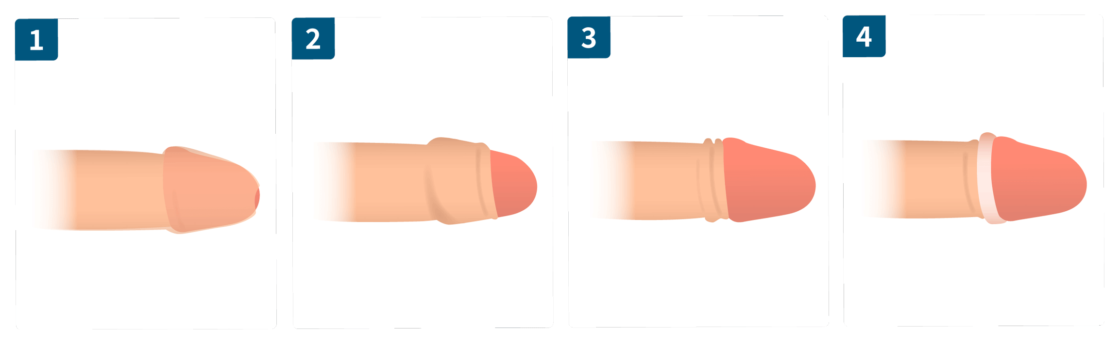 カントン包茎の種類