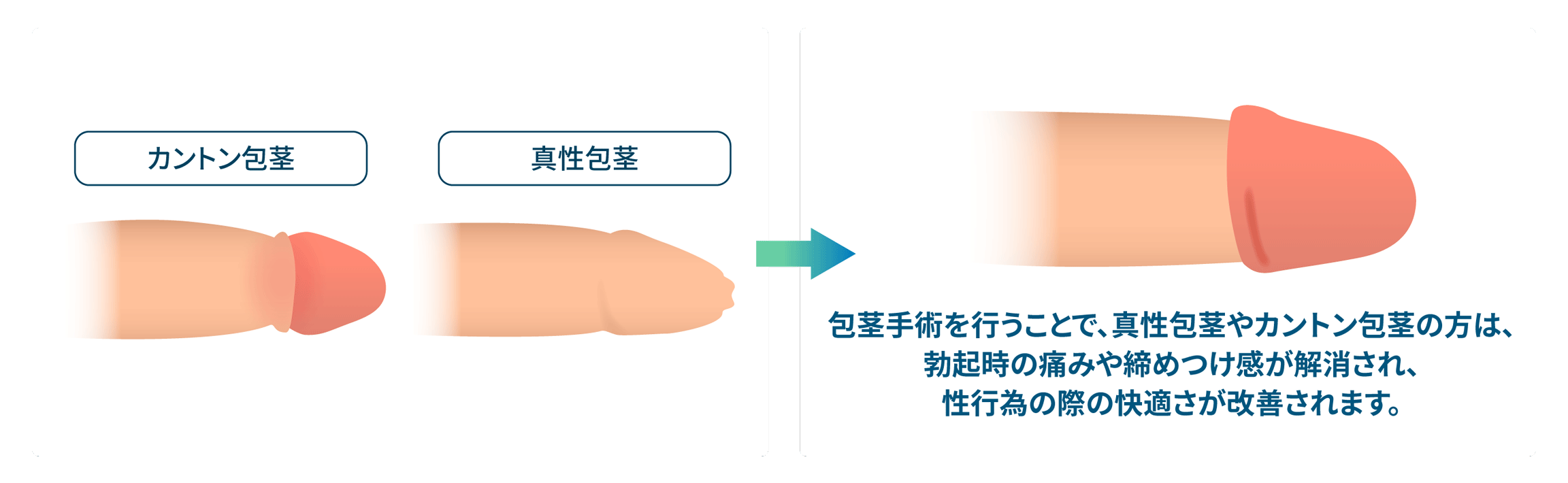 勃起時の痛みと圧迫感の解消