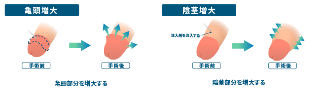 亀頭増大・陰茎増大の違い