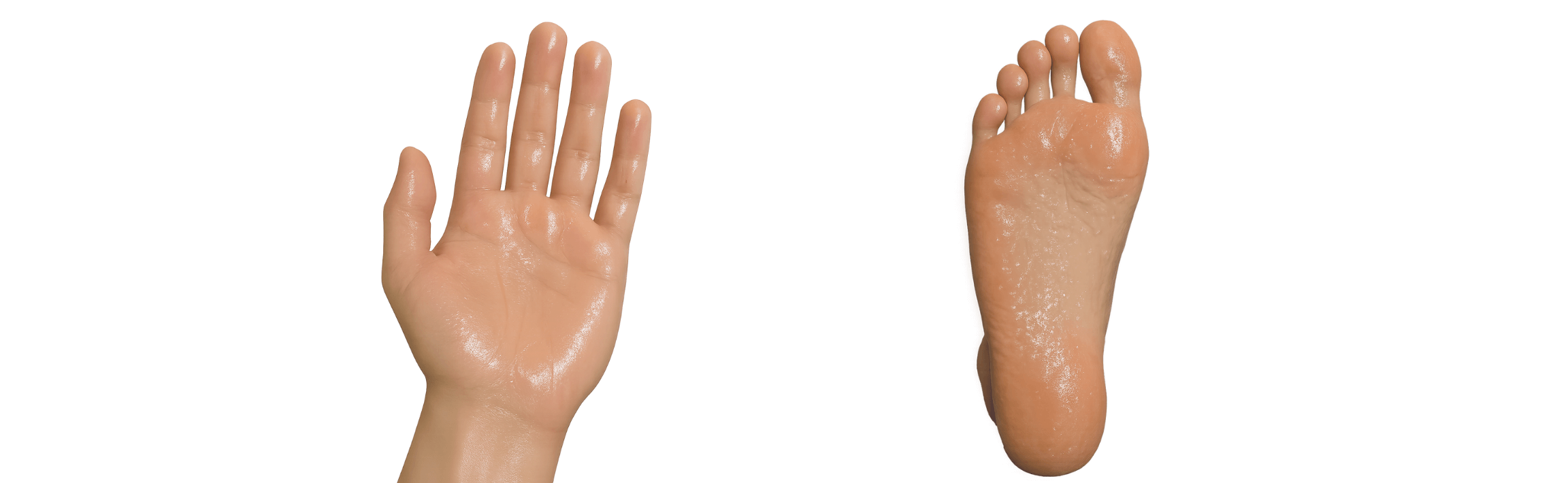 手足の多汗症（原発性掌蹠多汗症）とは