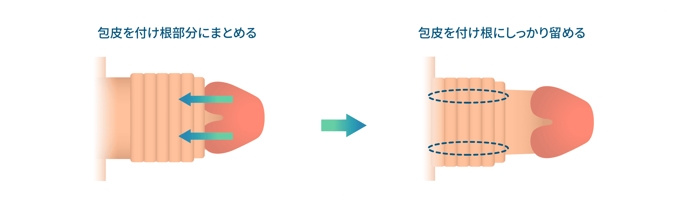 当院の非切開包茎治療