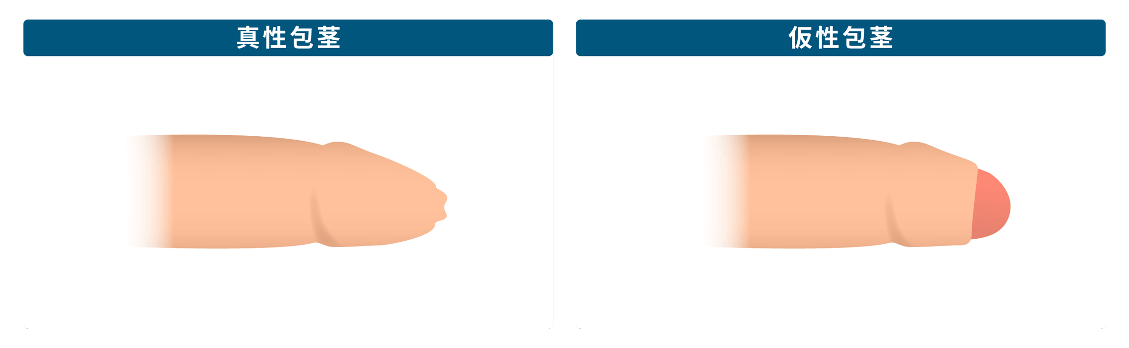 仮性包茎と真性包茎の違い